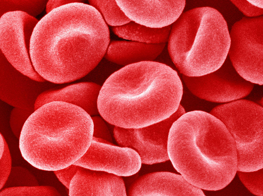 Low Red Blood Cells - Understanding Anemia