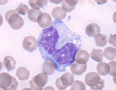 White Blood Cells - Elevation Does Not Always Mean Infection!