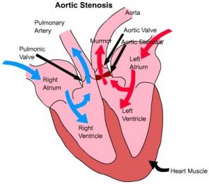 Subaortic Stenosis in Dogs & Cats – An Important Congenital Heart Defect