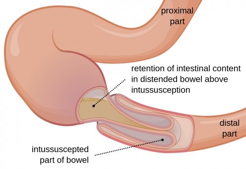 intussusception
